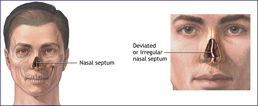 what is a deviated septum